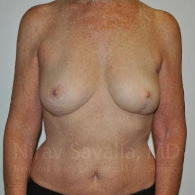 Oncoplastic Reconstruction Before & After Gallery - Patient 1655481 - Image 2