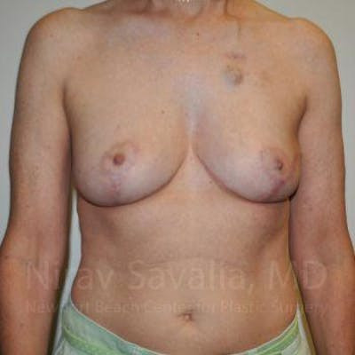 Oncoplastic Reconstruction Before & After Gallery - Patient 1655487 - Image 2
