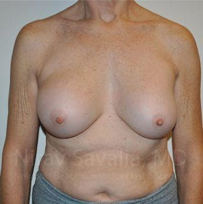 Breast Implant Revision Before & After Gallery - Patient 1655567 - Image 1
