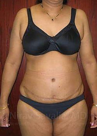 Liposuction Before & After Gallery - Patient 1655665 - Image 2