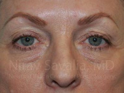 Eyelid Surgery Before & After Gallery - Patient 1655707 - Image 1