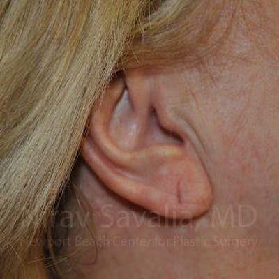 Torn Earlobe Repair Ear Gauge Repair Before & After Gallery - Patient 1655722 - Image 1