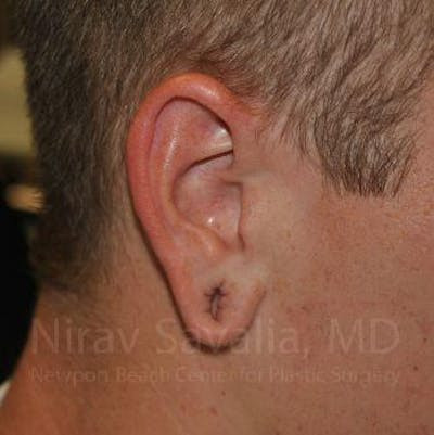 Torn Earlobe Repair Ear Gauge Repair Before & After Gallery - Patient 1655727 - Image 1