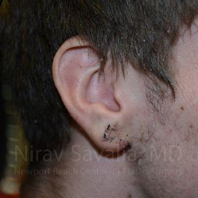 Torn Earlobe Repair Ear Gauge Repair Before & After Gallery - Patient 1655788 - Image 2