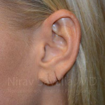 Torn Earlobe Repair Ear Gauge Repair Before & After Gallery - Patient 1655792 - Image 1